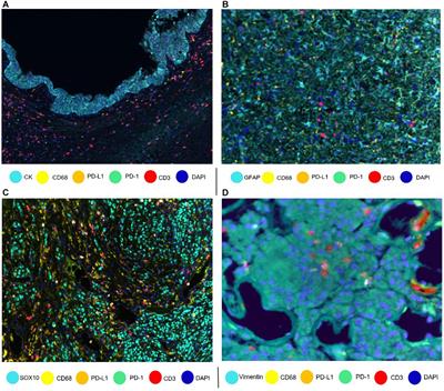 Multiplex Immunofluorescence Tyramide Signal Amplification for Immune Cell Profiling of Paraffin-Embedded Tumor Tissues